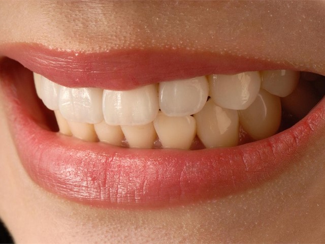 Consejos para prolongar la vida de tus carillas dentales