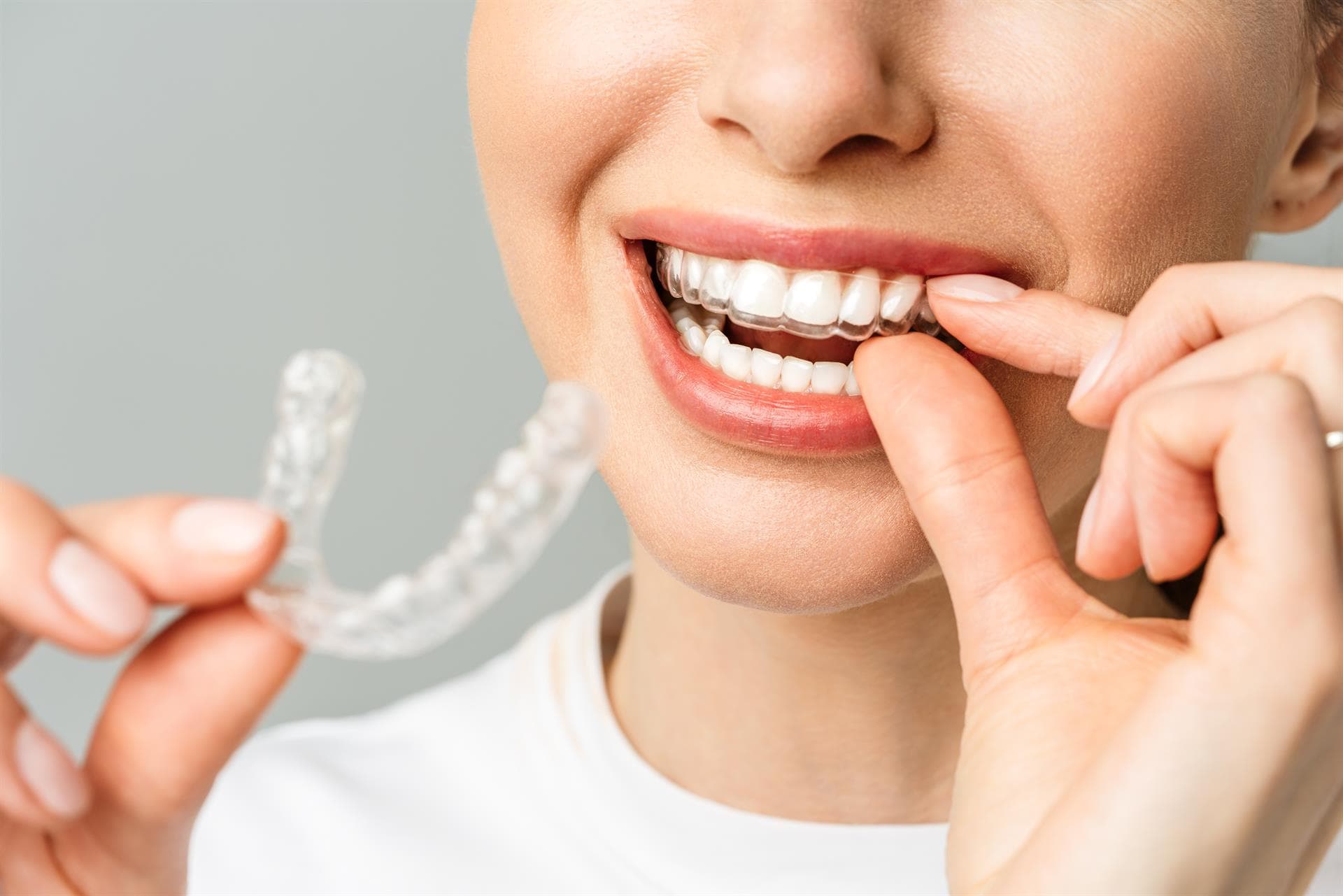 Opta por la ortodoncia invisible para corregir tu sonrisa