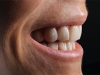¡15% de descuento en tratamientos de carillas dentales!
