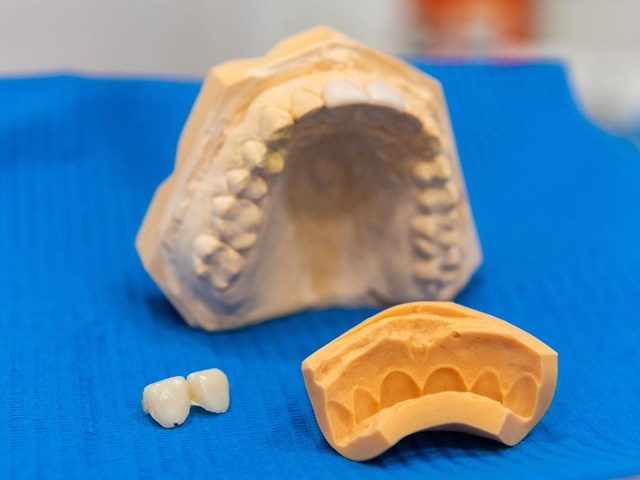 5 cosas que debes saber sobre las prótesis dentales