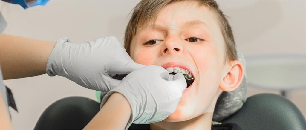¿A partir de qué edad se puede utilizar aparato dental?