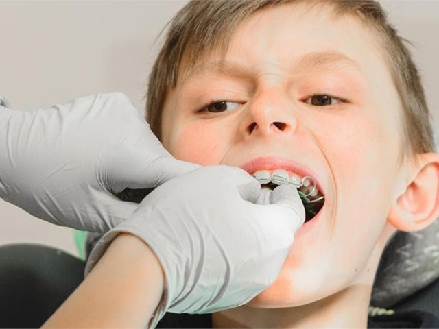 ¿A partir de qué edad se puede utilizar aparato dental?