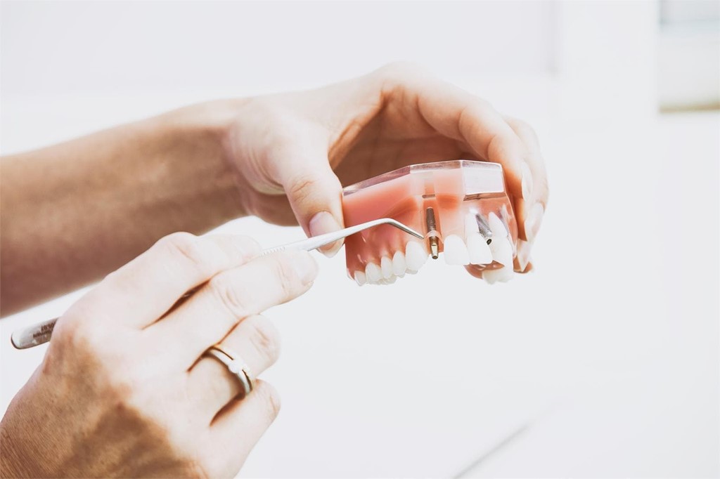 ¿Cómo limpiar mis implantes dentales? 