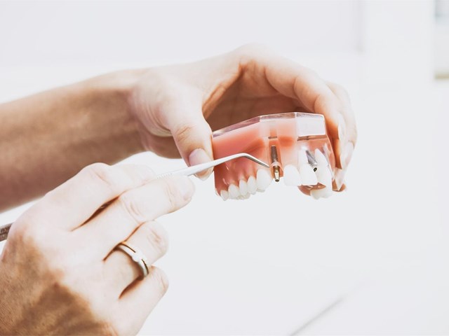 ¿Cómo limpiar mis implantes dentales? 