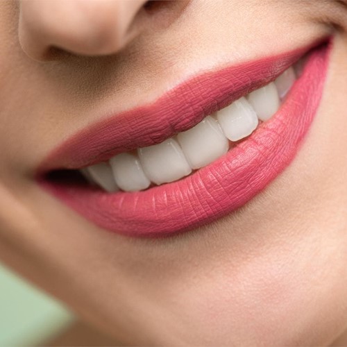 ¿Cómo se colocan las carillas dentales de composite?