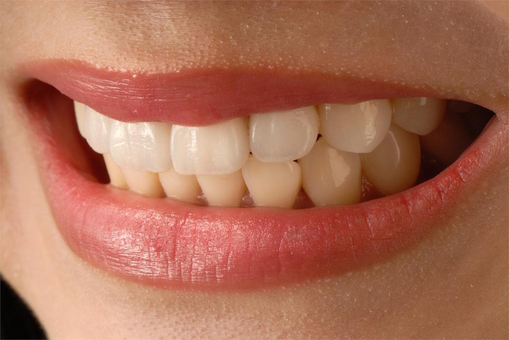 Consejos para prolongar la vida de tus carillas dentales