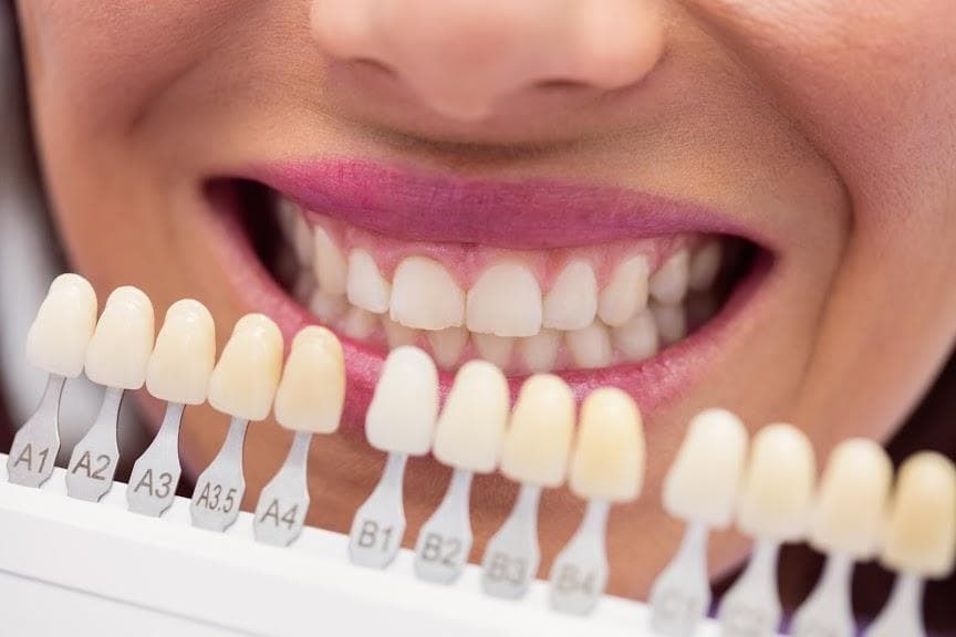 ¿Cuánto cuesta un tratamiento de carillas dentales? - Imagen 1