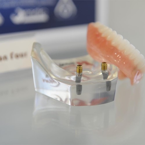 ¿Cuánto tiempo dura un tratamiento de implante dental?