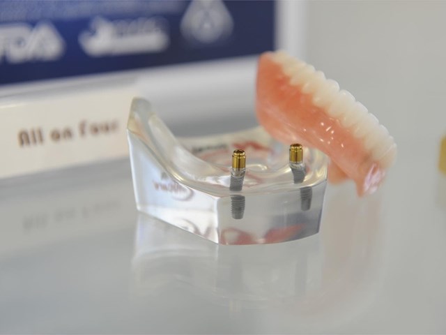 ¿Cuánto tiempo dura un tratamiento de implante dental?