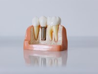 ¿Cuánto tiempo duran unos implantes dentales?