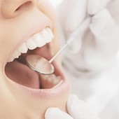 Descubre las carillas dentales