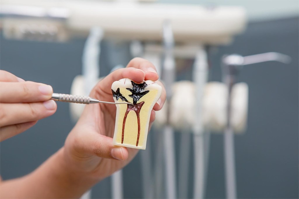 ¿Es posible que una endodoncia salga mal y que termine perdiendo igualmente la pieza dental?