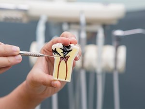 ¿Es posible que una endodoncia salga mal y que termine perdiendo igualmente la pieza dental?
