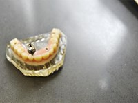 ¿Es posible tener mis implantes dentales en el mismo día?