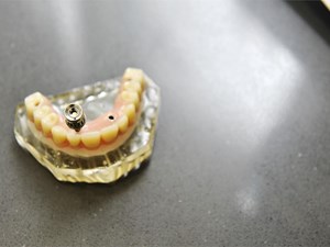 ¿Es posible tener mis implantes dentales en el mismo día?