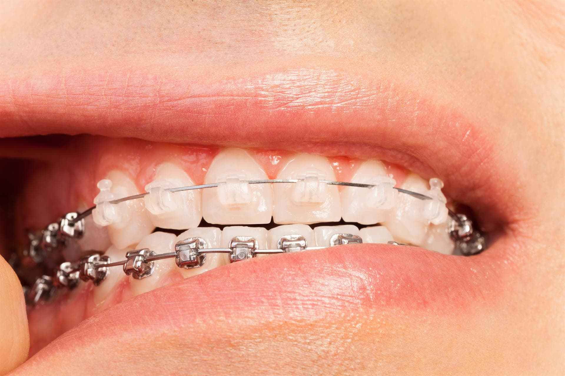  Inicia ya tu tratamiento con brackets transparentes en Santiago