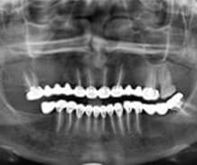 Radiografía de control (3 años de colocación)