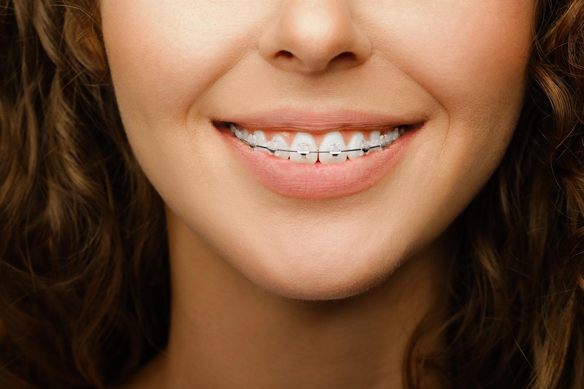 Corrige tu sonrisa con nuestros brackets estéticos