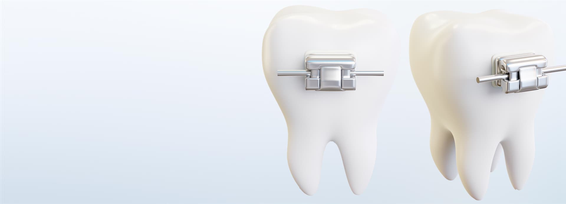 Precio de brackets metálicos en Santiago