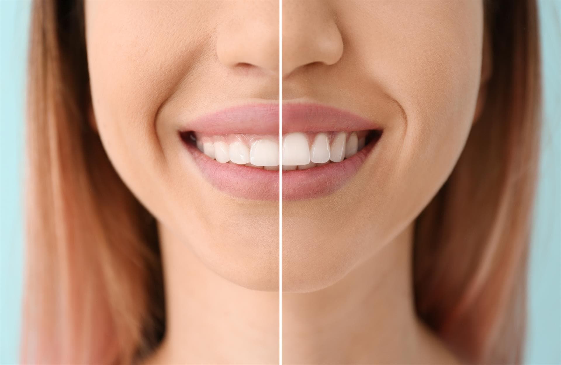 Gingivectomía y gingivoplastia