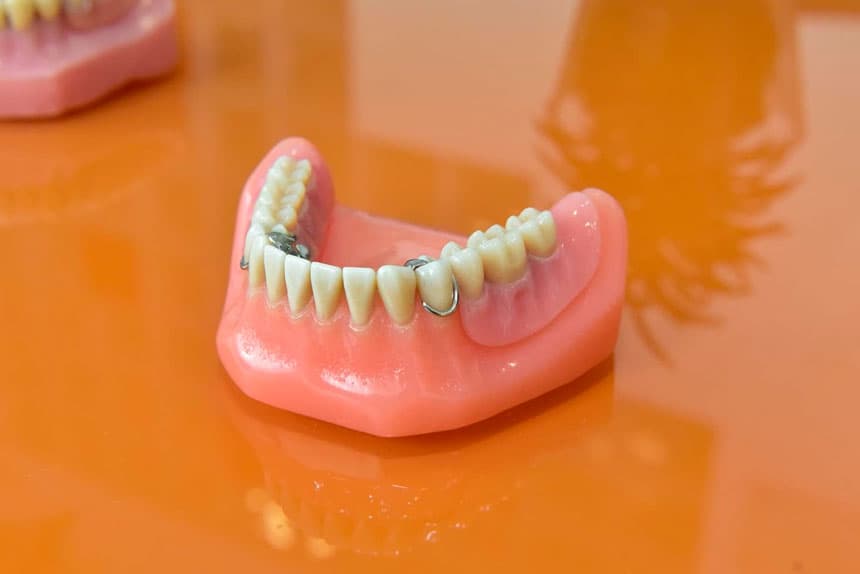 Implante dental en Santiago