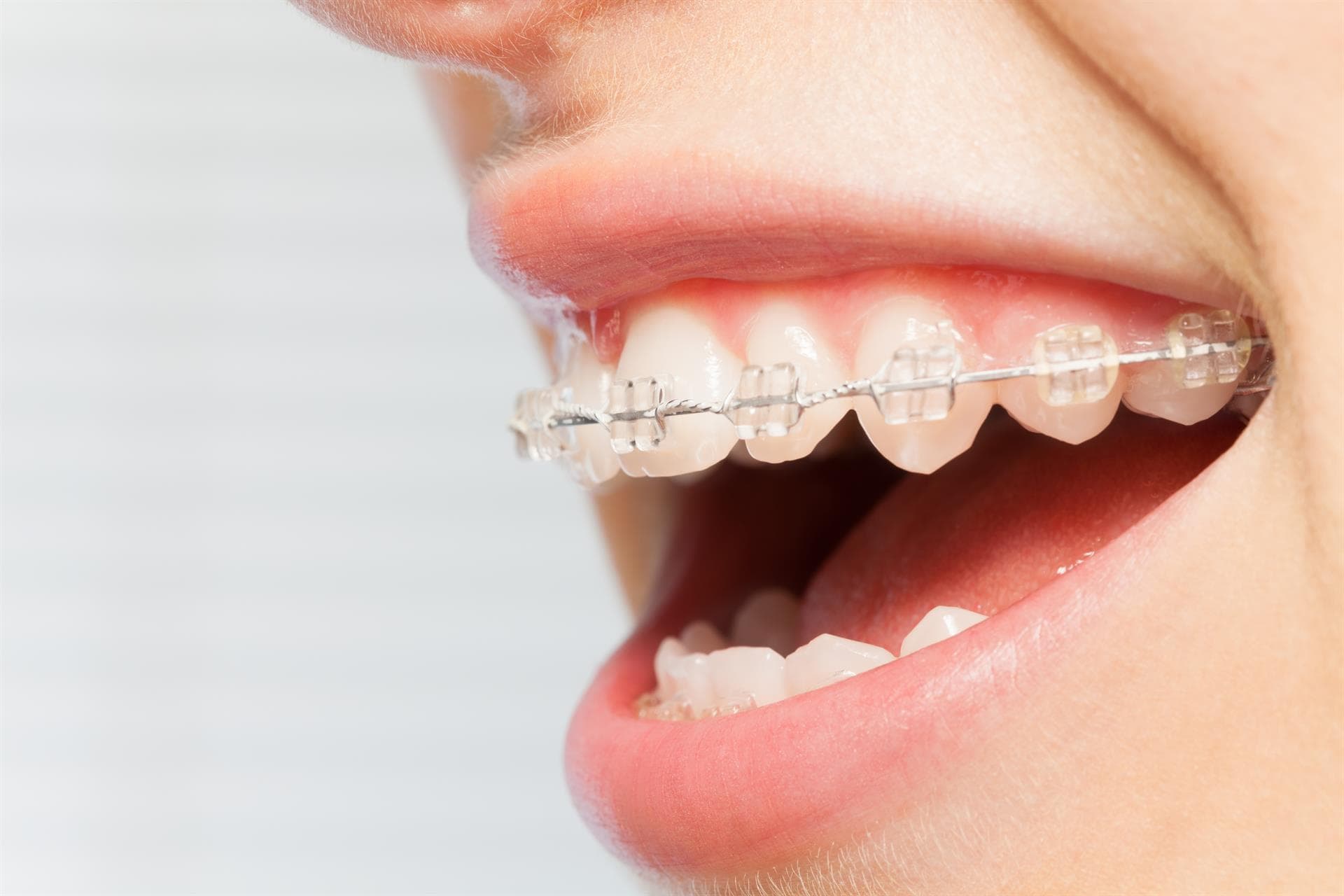 Corrige tu sonrisa con nuestros brackets estéticos