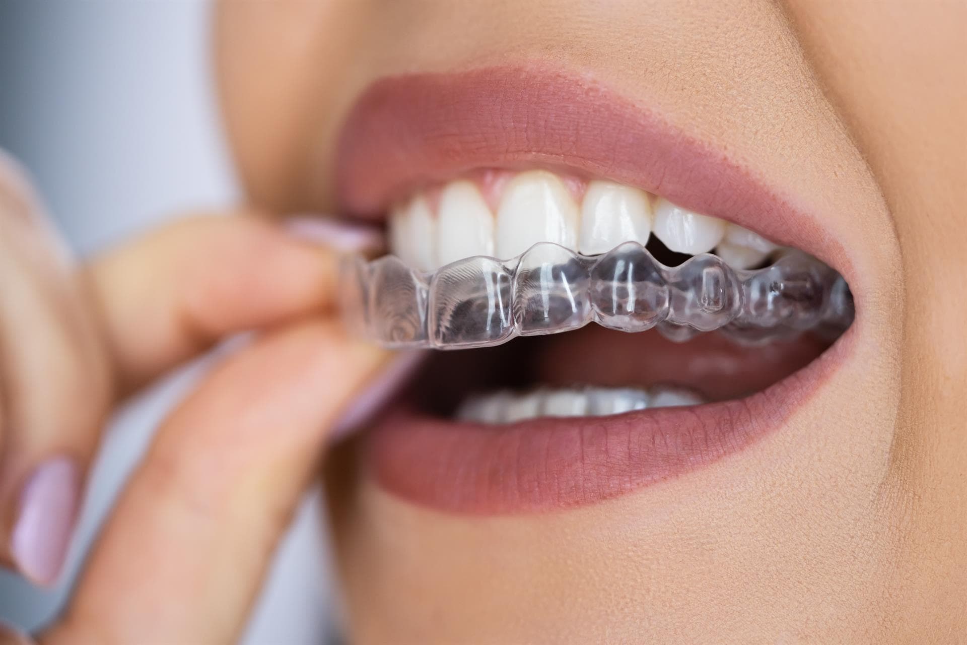 Invisalign en Santiago, la ortodoncia invisible que deseas