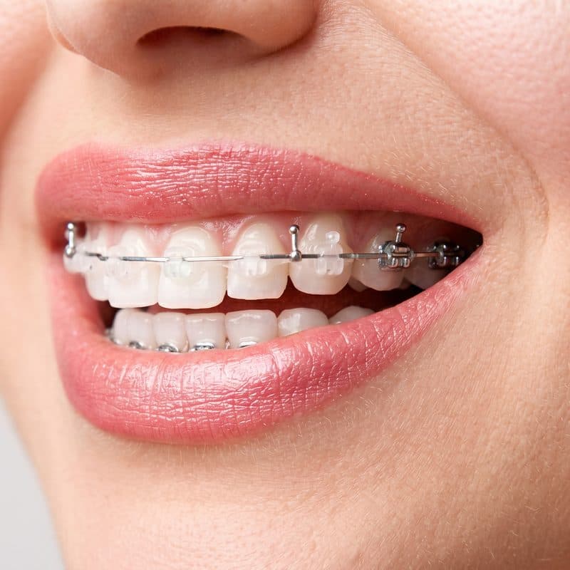 Brackets de zafiro transparentes en Santiago en Clínica Implanteoral Milladoiro