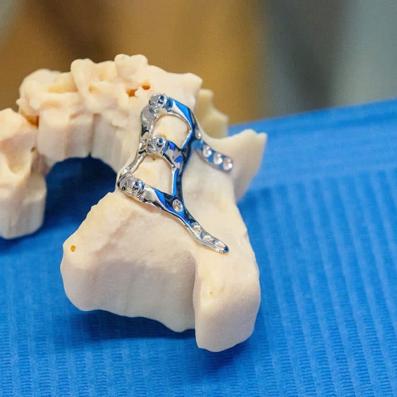 Implantes subperiósticos en Santiago en Clínica Implanteoral Milladoiro
