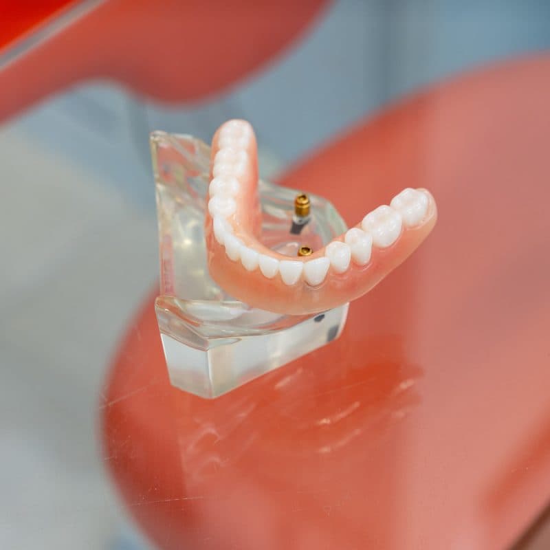 Prótesis dentales en Santiago en Clínica Implanteoral Milladoiro