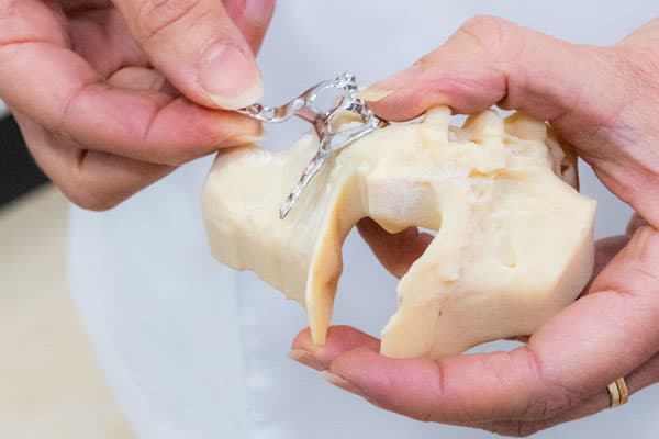 Colocación de implantes subperiósticos en Santiago
