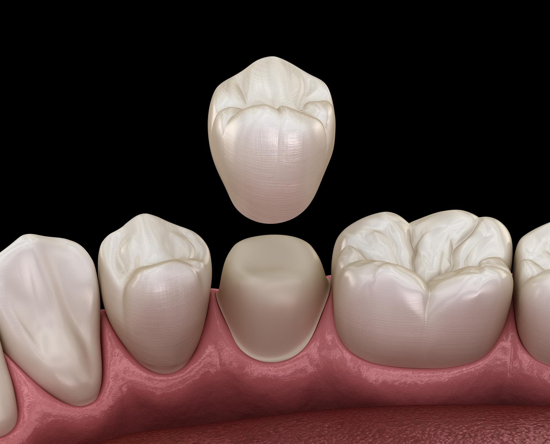 Dentistas expertos en prótesis dentales en Santiago