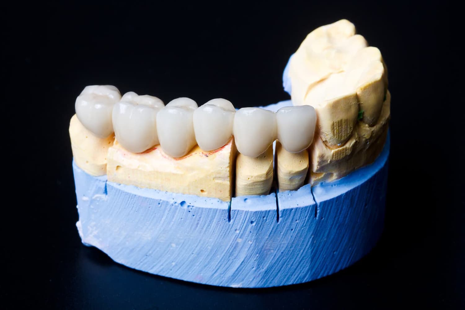 Prótesis dentales de zirconio