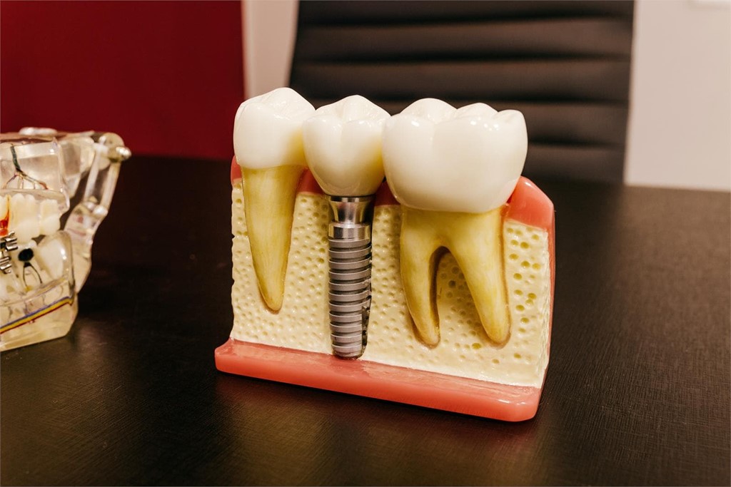 Implanteoral - Diferencias entre Implantes All on Four e Implantes Cigomáticos