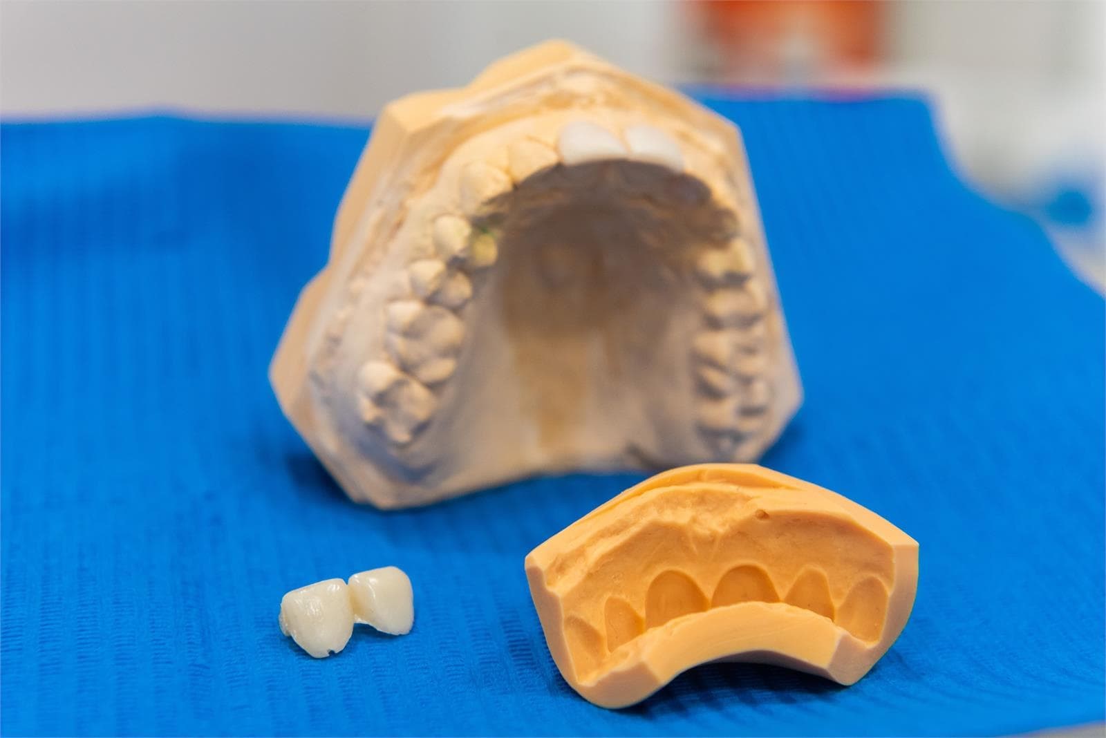 Implanteoral - Diferencias entre Implantes All on Four e Implantes Cigomáticos - Imagen 1