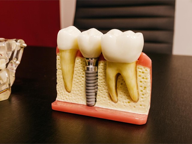 Implanteoral - Diferencias entre Implantes All on Four e Implantes Cigomáticos