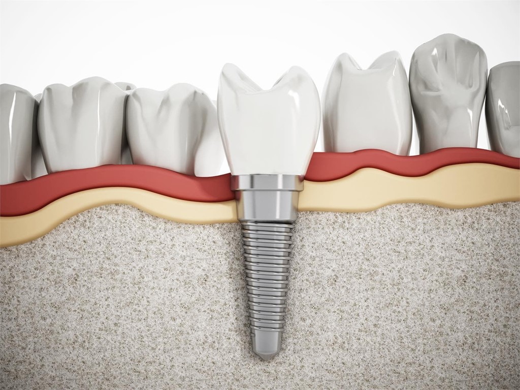 Implantes cigomáticos