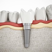 Implantes cigomáticos