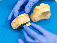 ¿Las carillas dentales pueden dañar mis dientes?