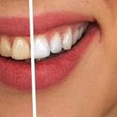 Lo que debes tener en cuenta al hacer un blanqueamiento dental