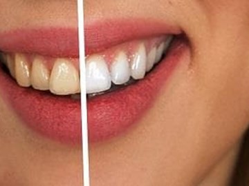 Lo que debes tener en cuenta al hacer un blanqueamiento dental