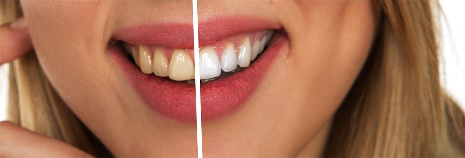 Luce unos dientes perfectos desde 450€ - Imagen 1