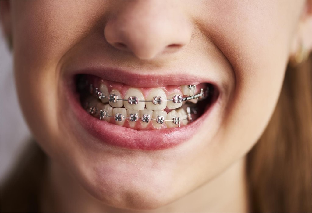 ¿Puedo comer cualquier alimento con los brackets?