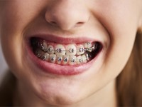 ¿Puedo comer cualquier alimento con los brackets?