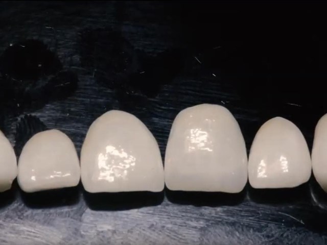 ¿Qué son las carillas dentales y para qué sirven?