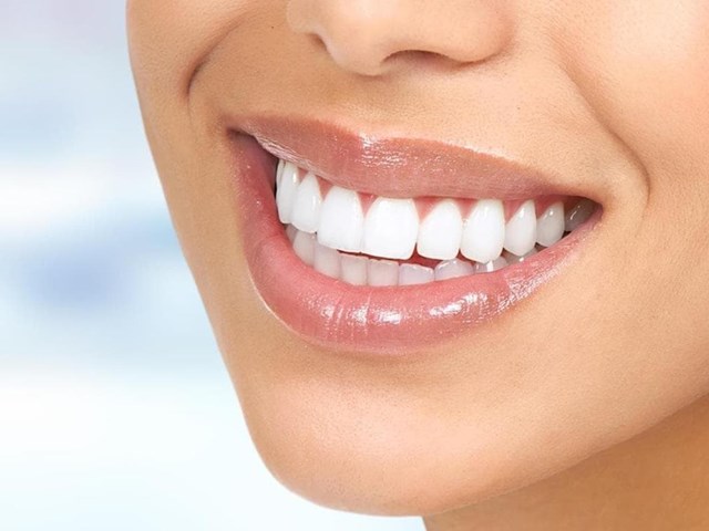 ¿Qué son las carillas dentales?