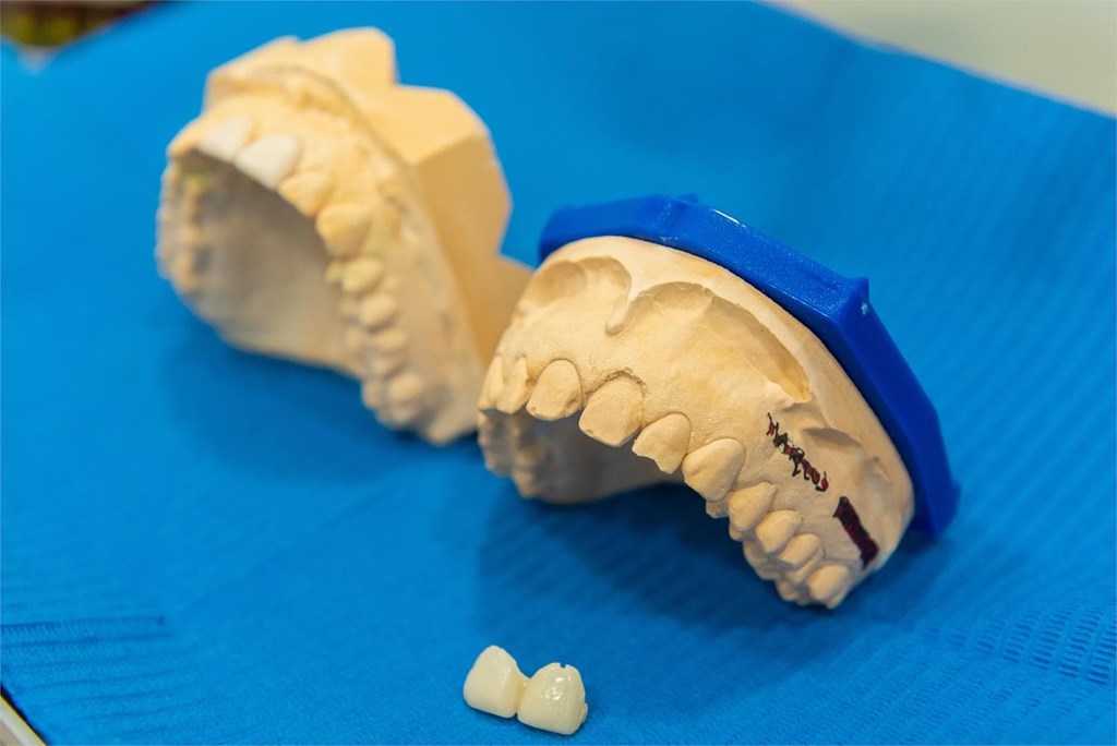¿Qué tener en cuenta a la hora de someterse a un tratamiento de carillas dentales?