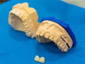 ¿Qué tener en cuenta a la hora de someterse a un tratamiento de carillas dentales?