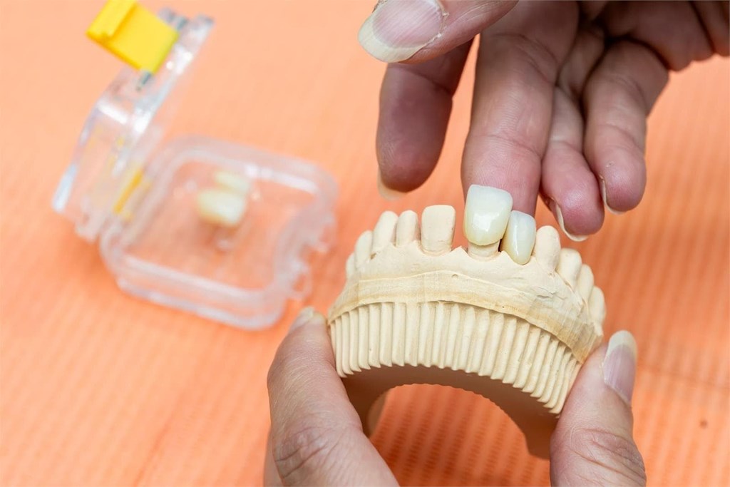 ¿Se pueden poner a la vez varios implantes dentales?