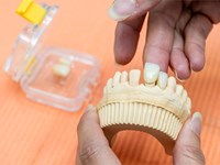 ¿Se pueden poner a la vez varios implantes dentales?